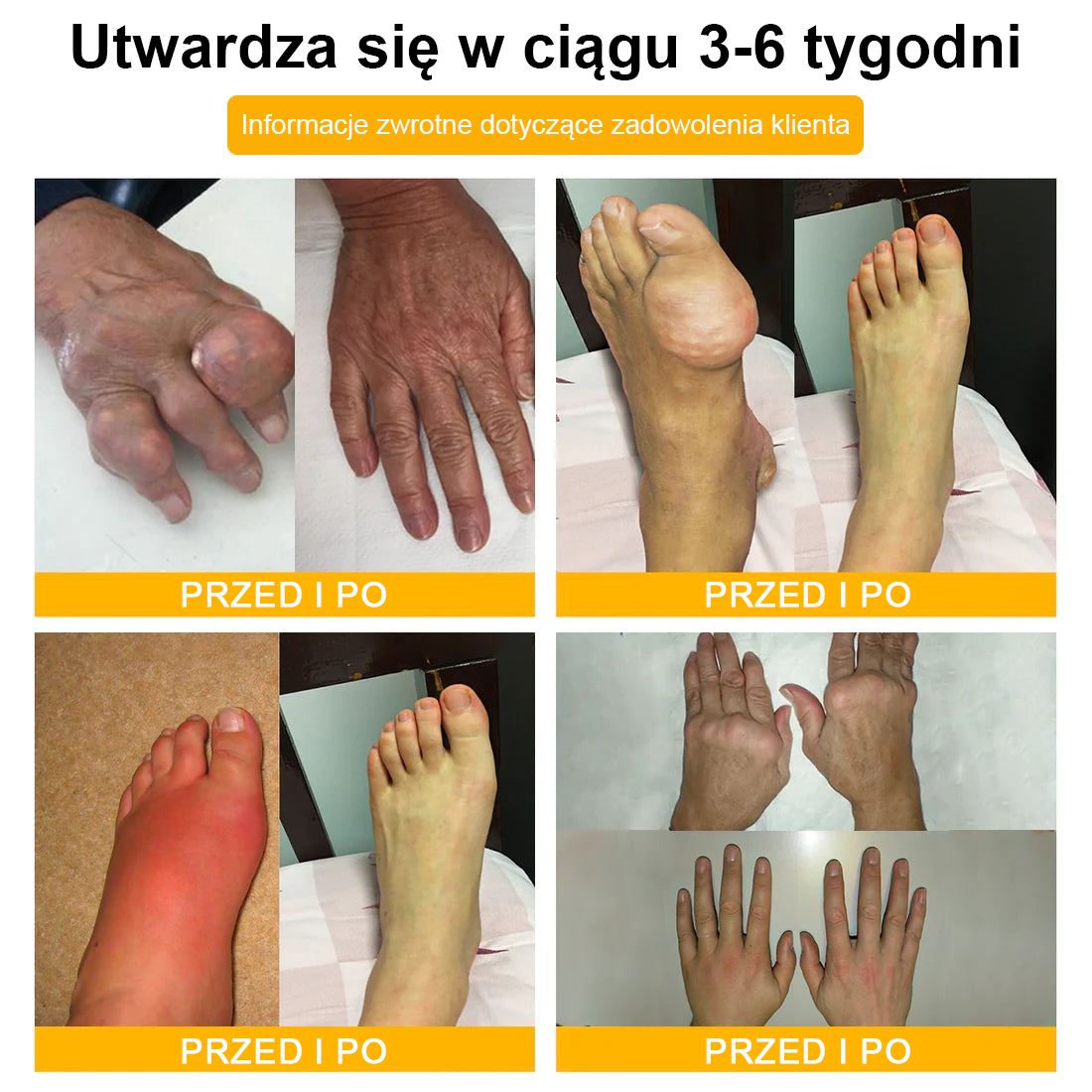 TLOPA® Toksyna botulinowa i jad pszczeli Krem przeciwbólowy do gojenia kości🐝🐝🐝